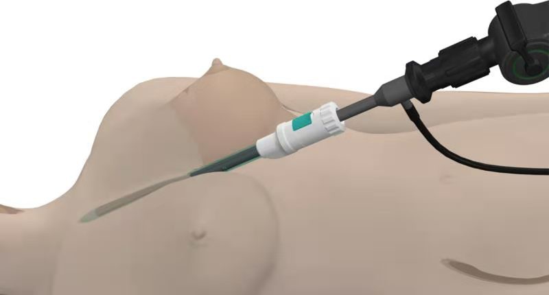 endoscopic thyroid&nbsp;operation.jpg