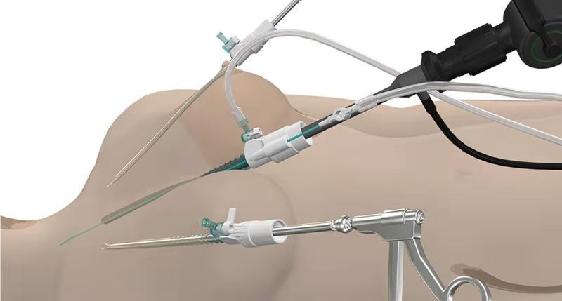 endoscopic thyroid&nbsp;surgery.jpg