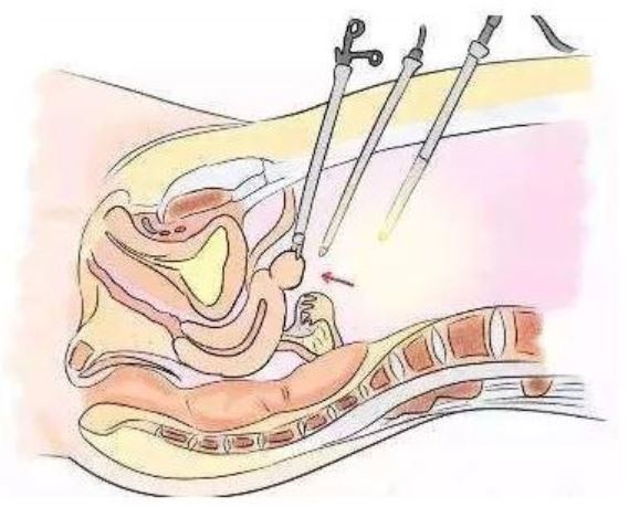 surgaid medical trocar surgaid medical trocar