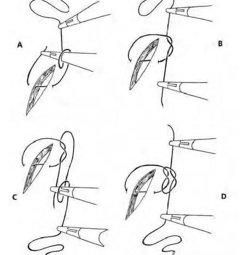 knotting in laparoscopic surgery 