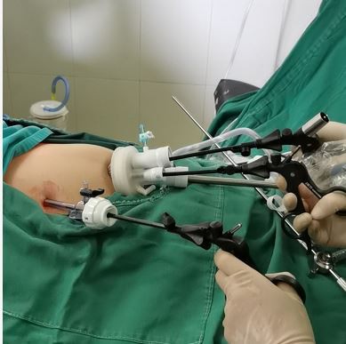 single incision laparoscopic sleeve single incision laparoscopic sleeve