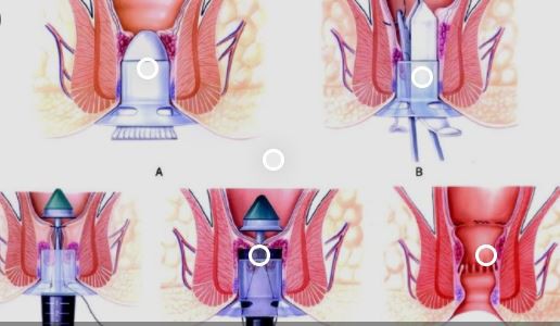 Hemorrhoid surgery PPH