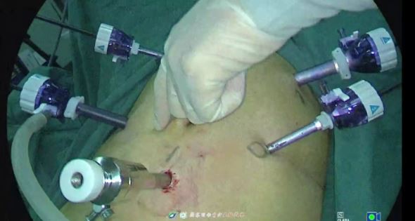 Minimally invasive