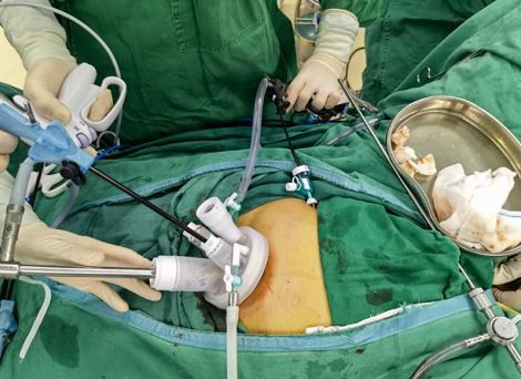 laparoscopic surgery (4) laparoscopic surgery (4)