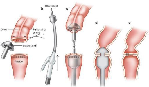intraluminal stapler operation