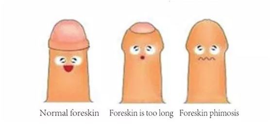 circumcision circumcision
