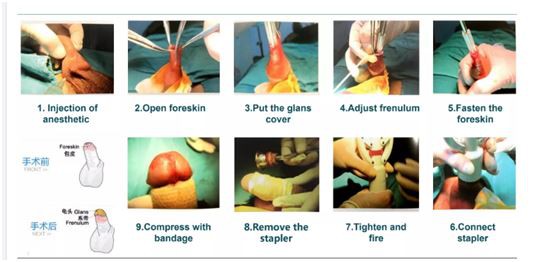 Circumcision surgery Circumcision surgery