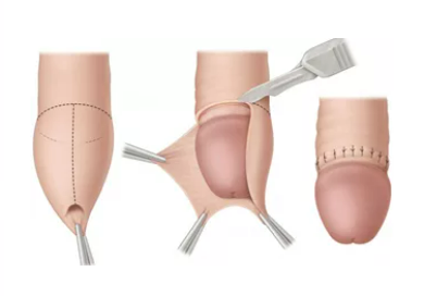 foreskin operation