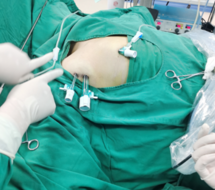 SURGERY THYROIDECTOMY TROCAR SURGERY THYROIDECTOMY TROCAR