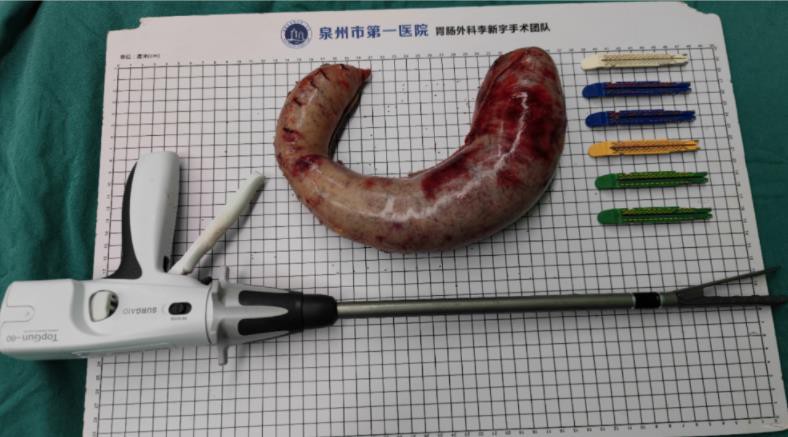 gastric incision bariatric surgery gastric incision bariatric surgery